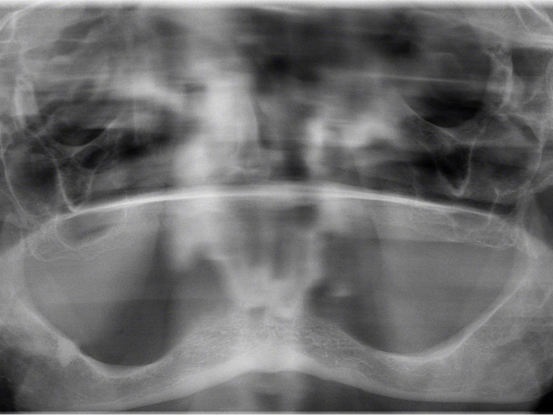 Straumann Pro Arch Konzept im atrophen Unterkiefer