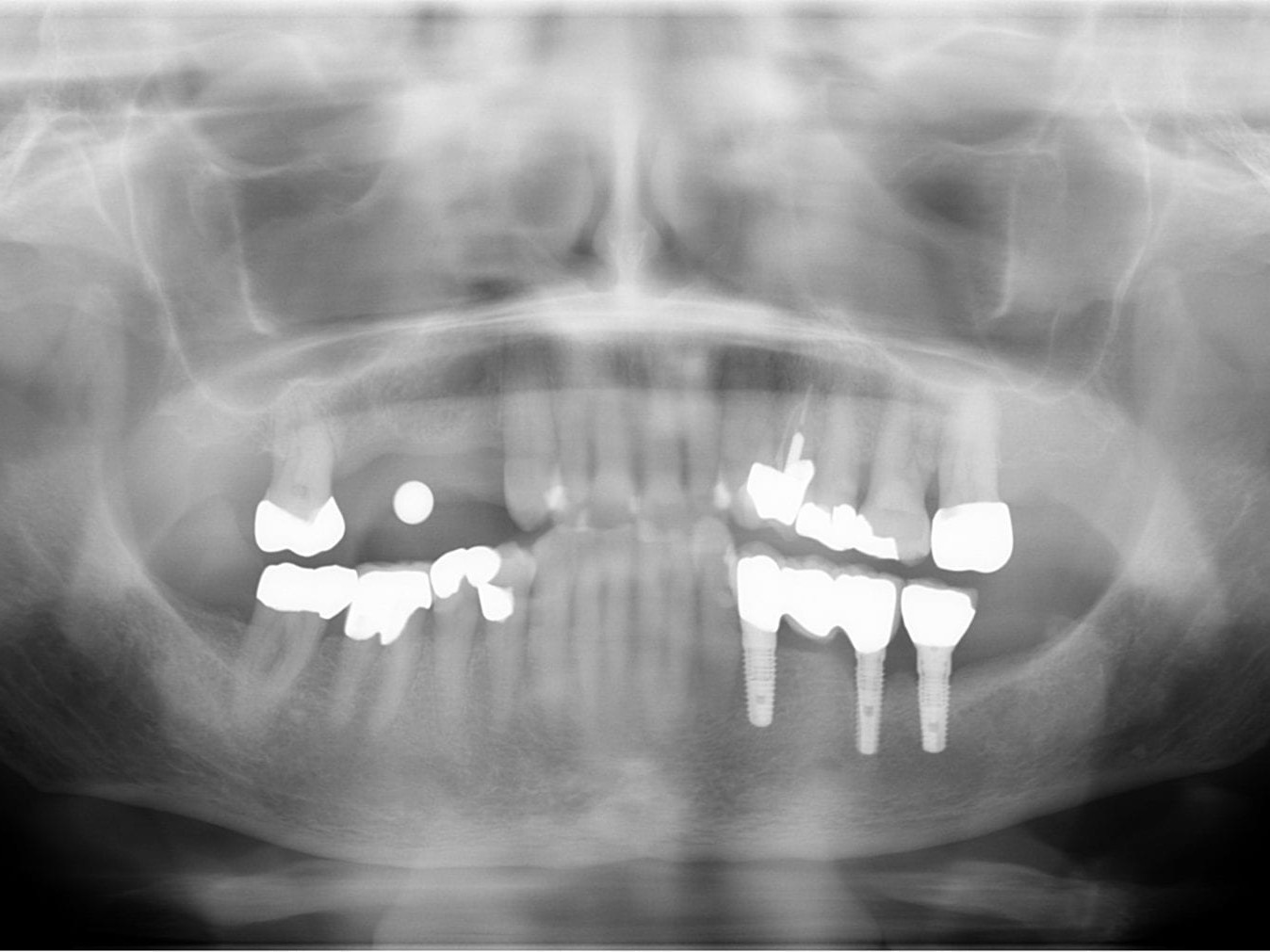 Abb. 2: präoperative Messkugelaufnahme