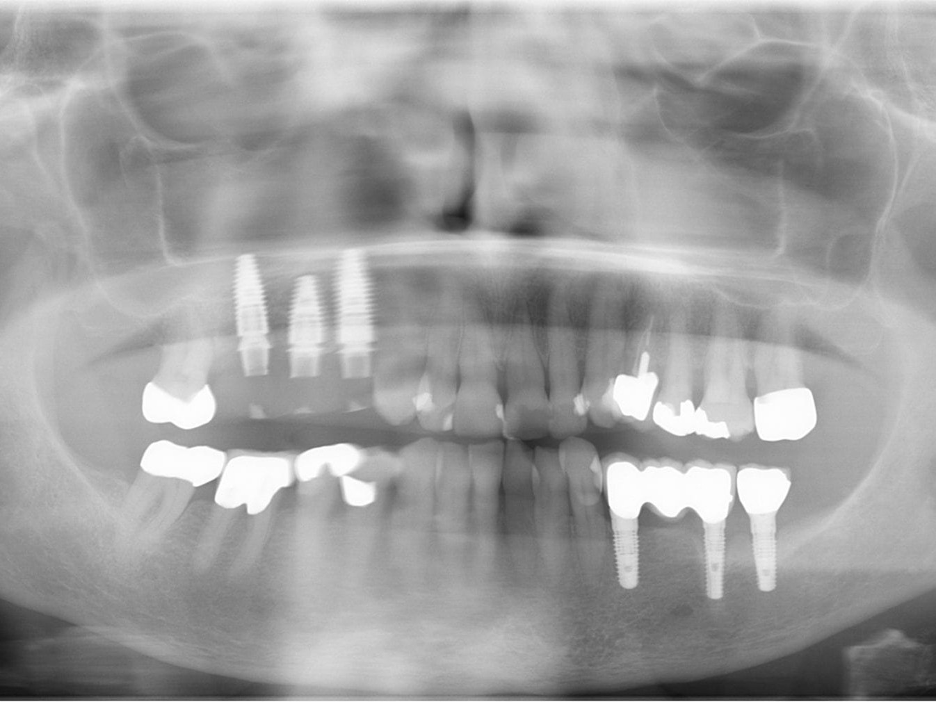 Abb. 3: verschraubtes und verblocktes Langzeitprovisorium aus PMMA