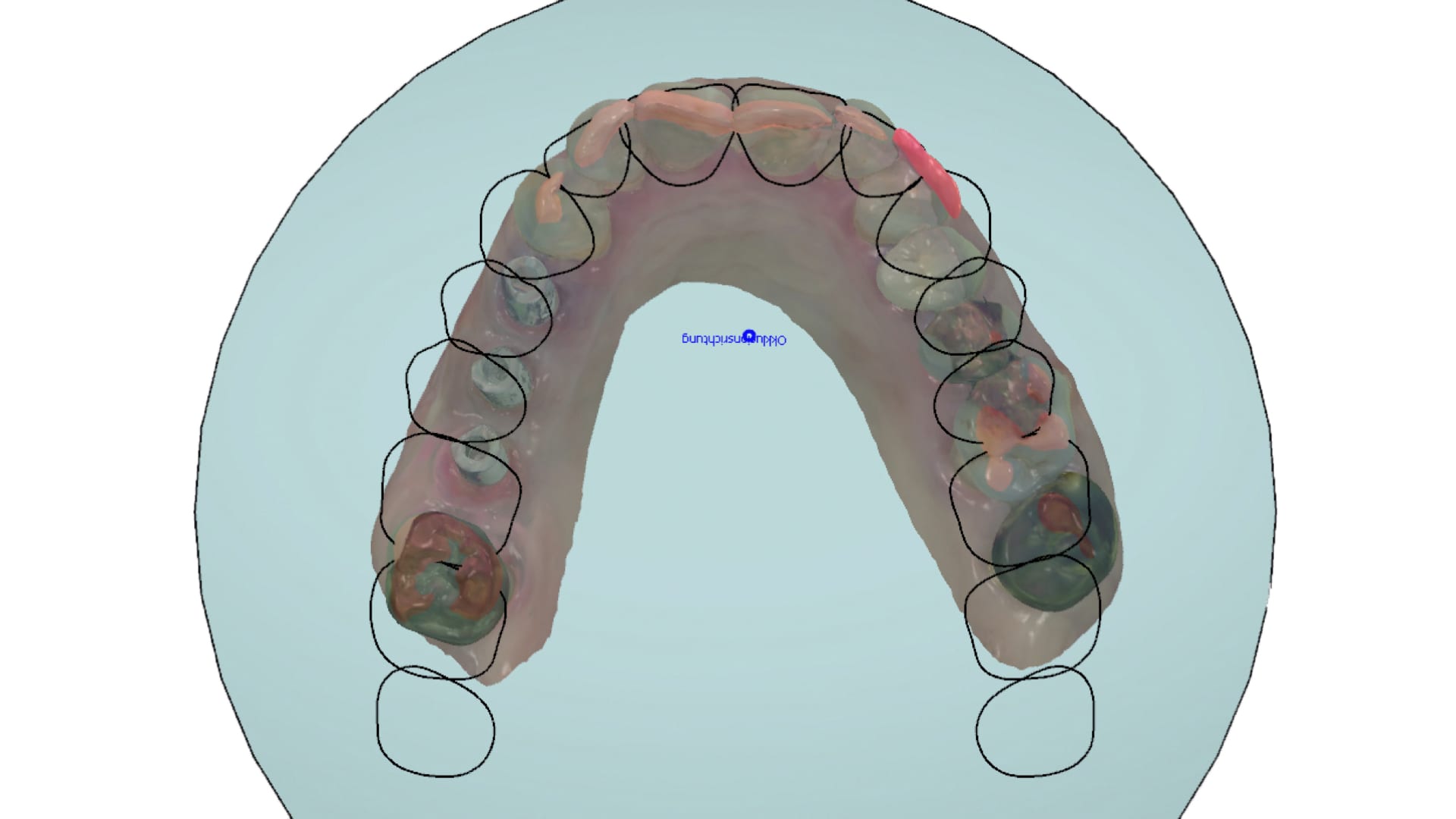 Abb. 7: Festlegung der Okklusionebene im Dental Designer