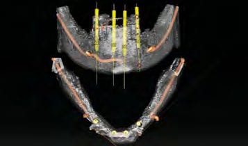 3D-Ansicht von vestibulär und okklusal