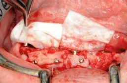 Abdeckung der stoma ossecure-Schrauben-fixierten Knochenaugmentate mittels zweier Remotis Membranen - Vestibuläransicht