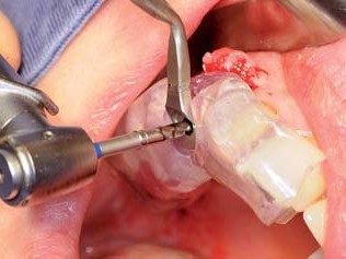 Bohrung über Guided Surgery