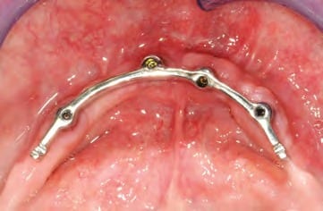 Der CAD/CAM-gefertigte Steg in situ - Okklusalansicht