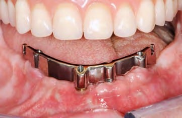 Der Steg in situ - Vestibuläransicht