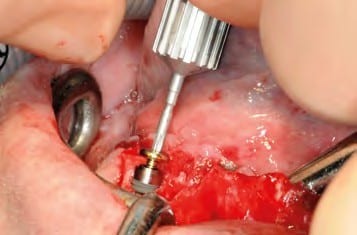 Einsetzen der Verschlusskappe