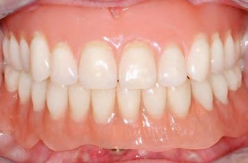 Endergebnis im Schlussbiss