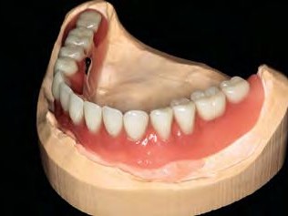 Fertiggestellte Prothese auf dem Meistermodell