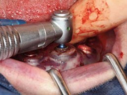 Implantat-Finalbohrer in Endposition