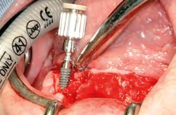 Insertion eines APLIQUIQ-konditionierten Implantats