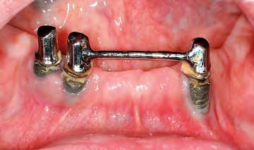 Klinische intraorale Ausgangssituation