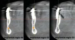 Knochendarstellung in orovestibulärer Richtung in Implantatposition
