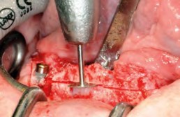 Korrektur des Implantbetts in der Höhe mittels Mikrosägescheibe