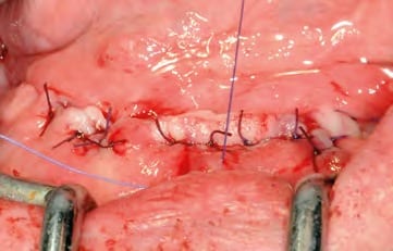 Naht-Wund-Verschluss