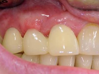 PMMA-Provisorium in situ