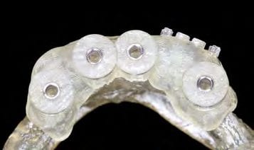 Pilotbohrschablone auf Unterkiefermodell