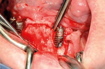 Präparation des Mukoperiostlappens...