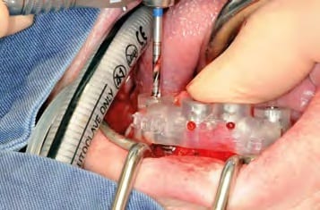 Schablonengeführte Pilotbohrungen mit 2,2 mm-Einmalpilotbohrer