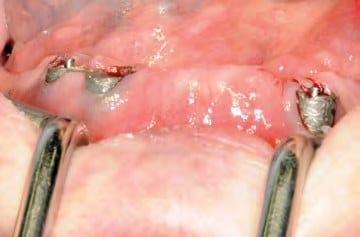 Situation nach Entfernung der obsoleten Implantatprothetik