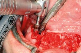 Spezifische Erweiterung für die SPI Contact RC-Implantate von Thommen Medical