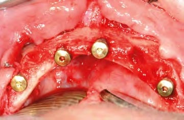 Sämtliche Implantate in situ - Okklusalansicht