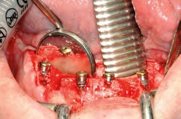 Sämtliche Implantate in situ - Vestibuläransicht