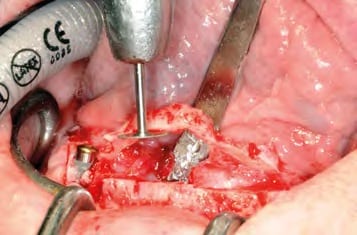 Vorsichtiges Bergen des Knochengrates