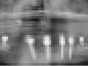 postoperatives Röntgenbild