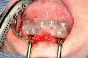 ...vor dem Einsetzen der SIMPLANT-Pilotschablone