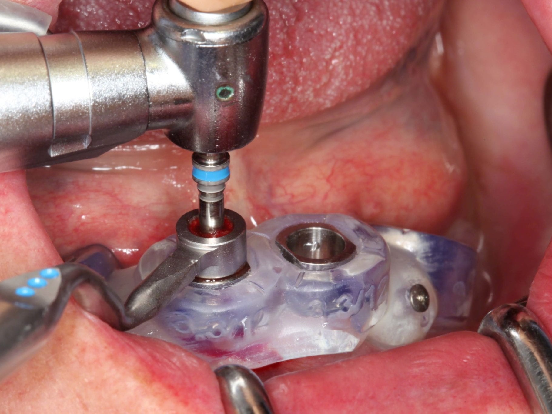 Abb 10 Aufbereitung der axialen Implantatstollen 1. Guided Bohrer