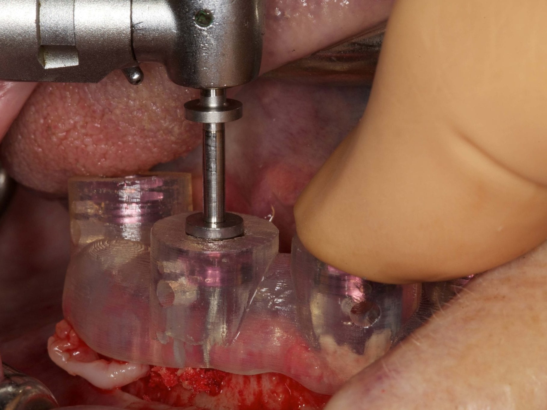 Abb 10 Bohrschablone in situ während Implantatbettaufbereitung