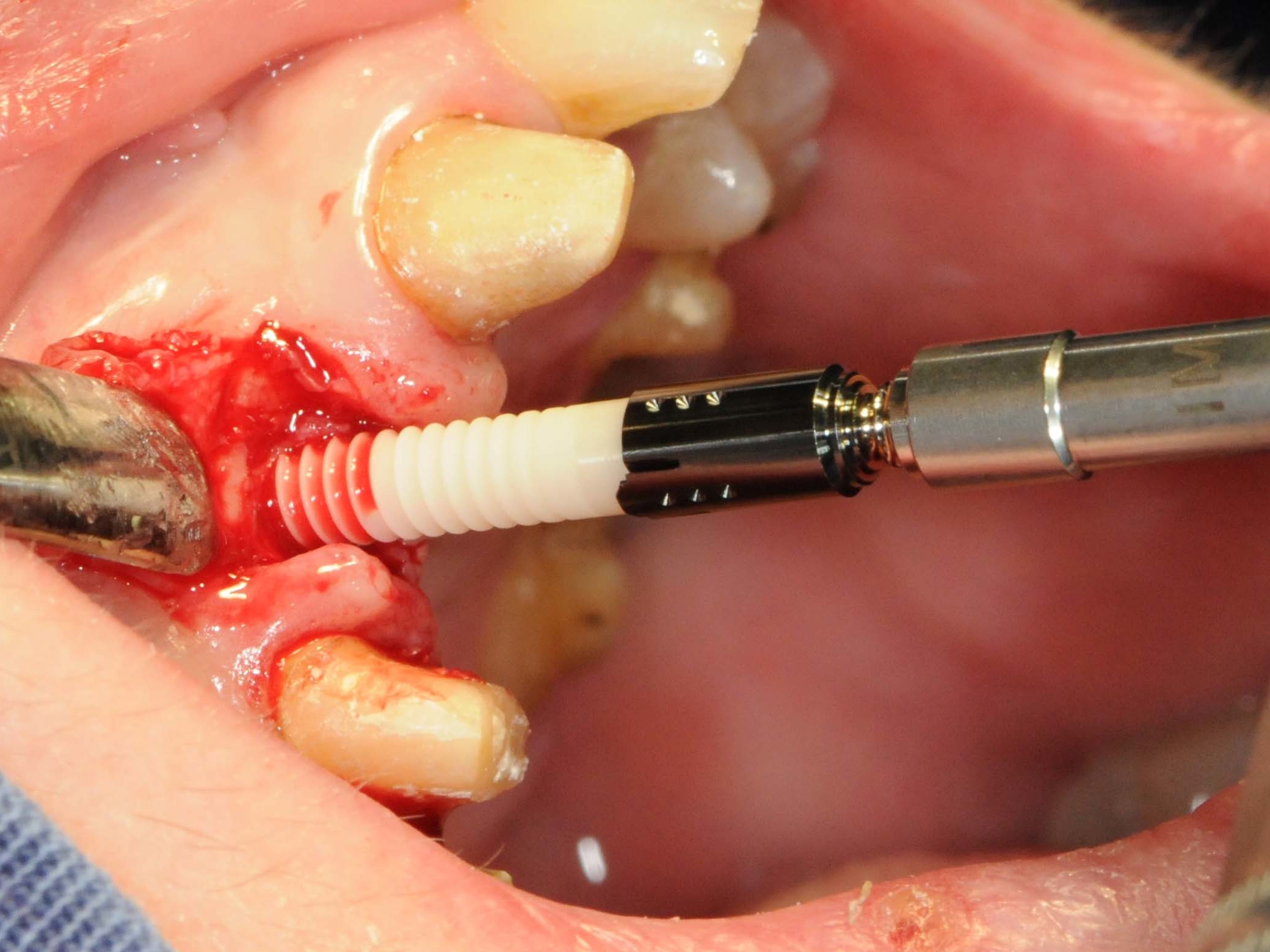 Abb 10 Einbringen des Straumann® PURE Ceramic Implantat