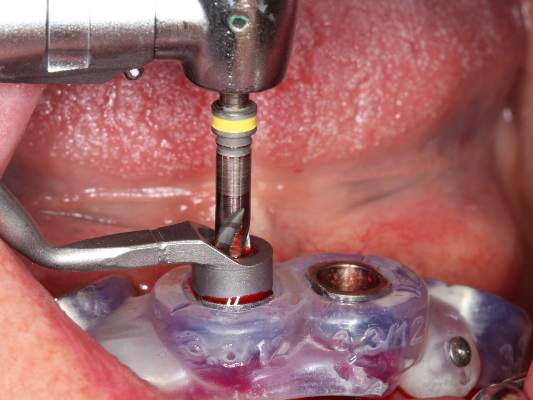 Abb 11 Aufbereitung der axialen Implantatstollen finaler Guided Bohrer