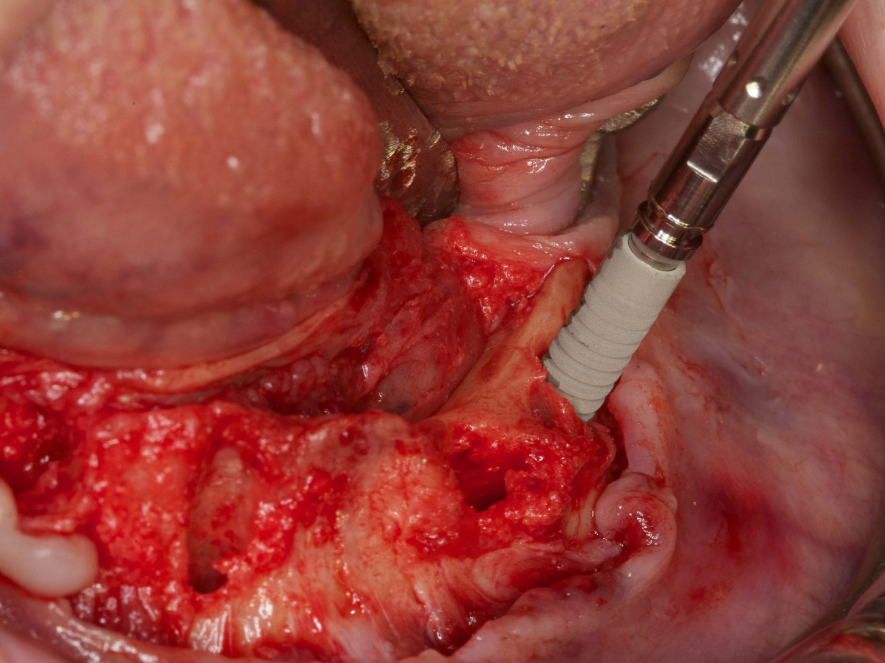 Abb 11 Insertion Implantat regio 034