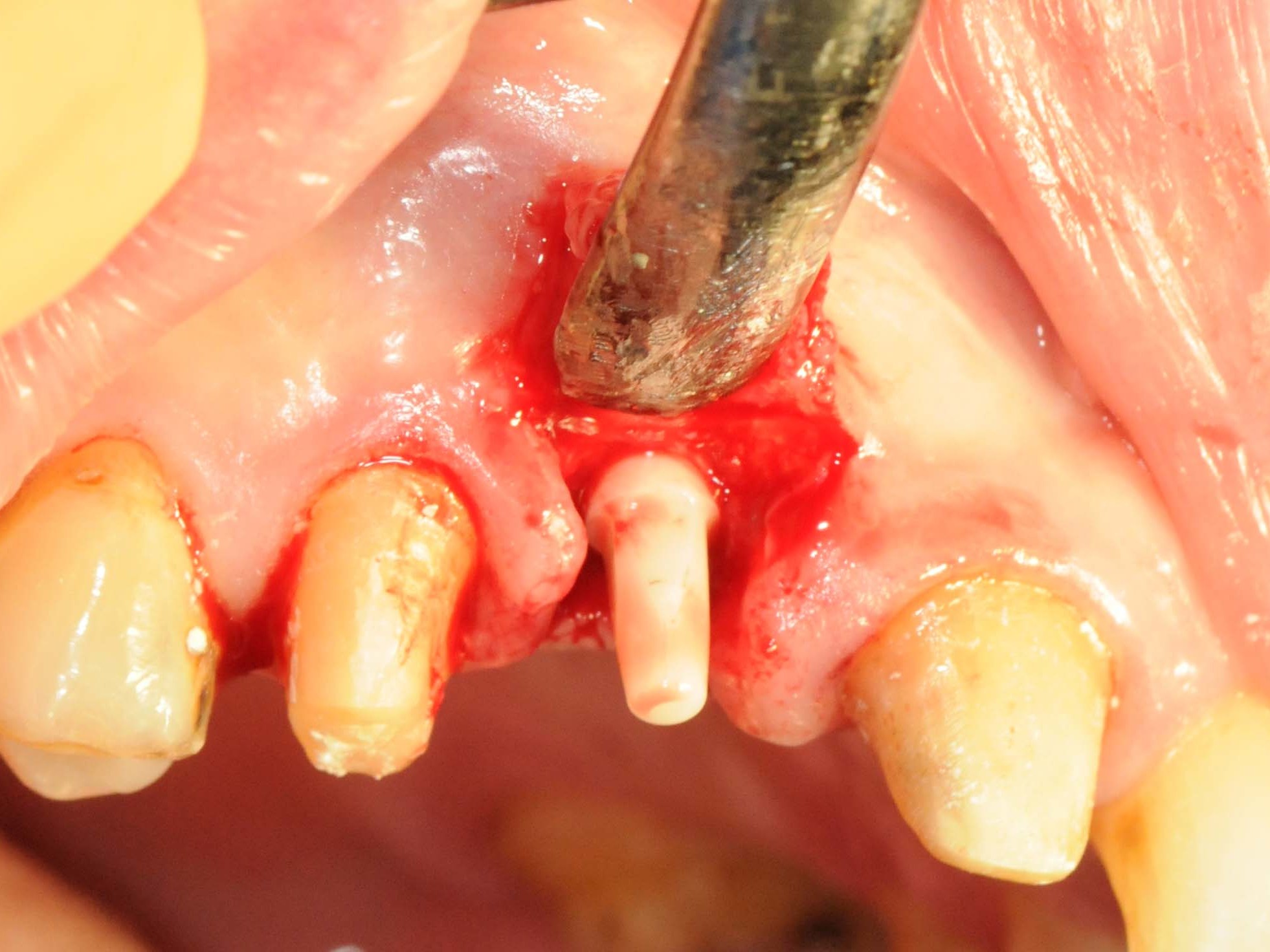 Abb 11 Straumann® PURE Ceramic Implantat in situ