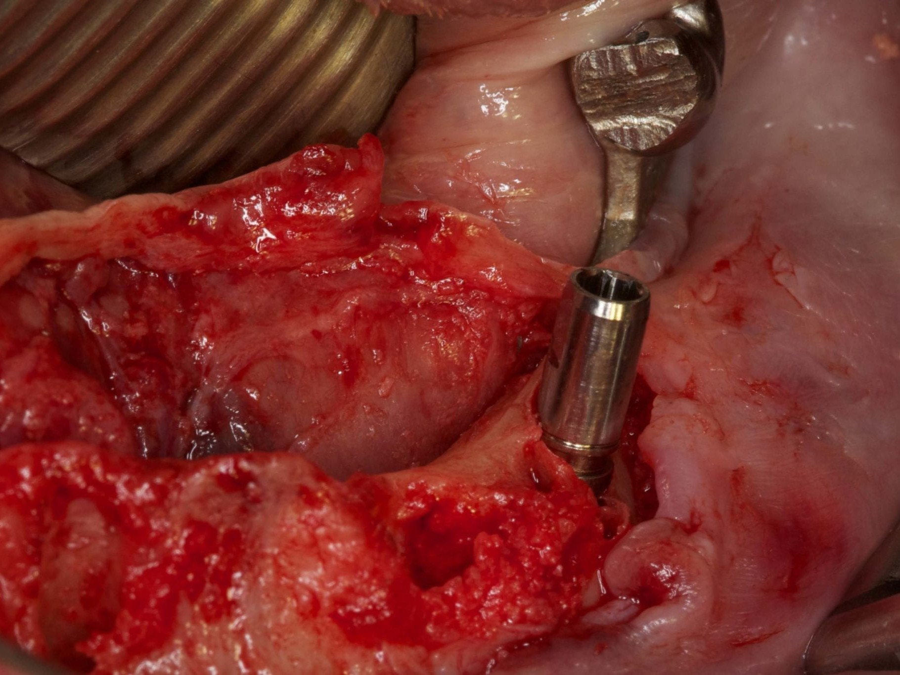 Abb 12 Implantat regio 034 in situ