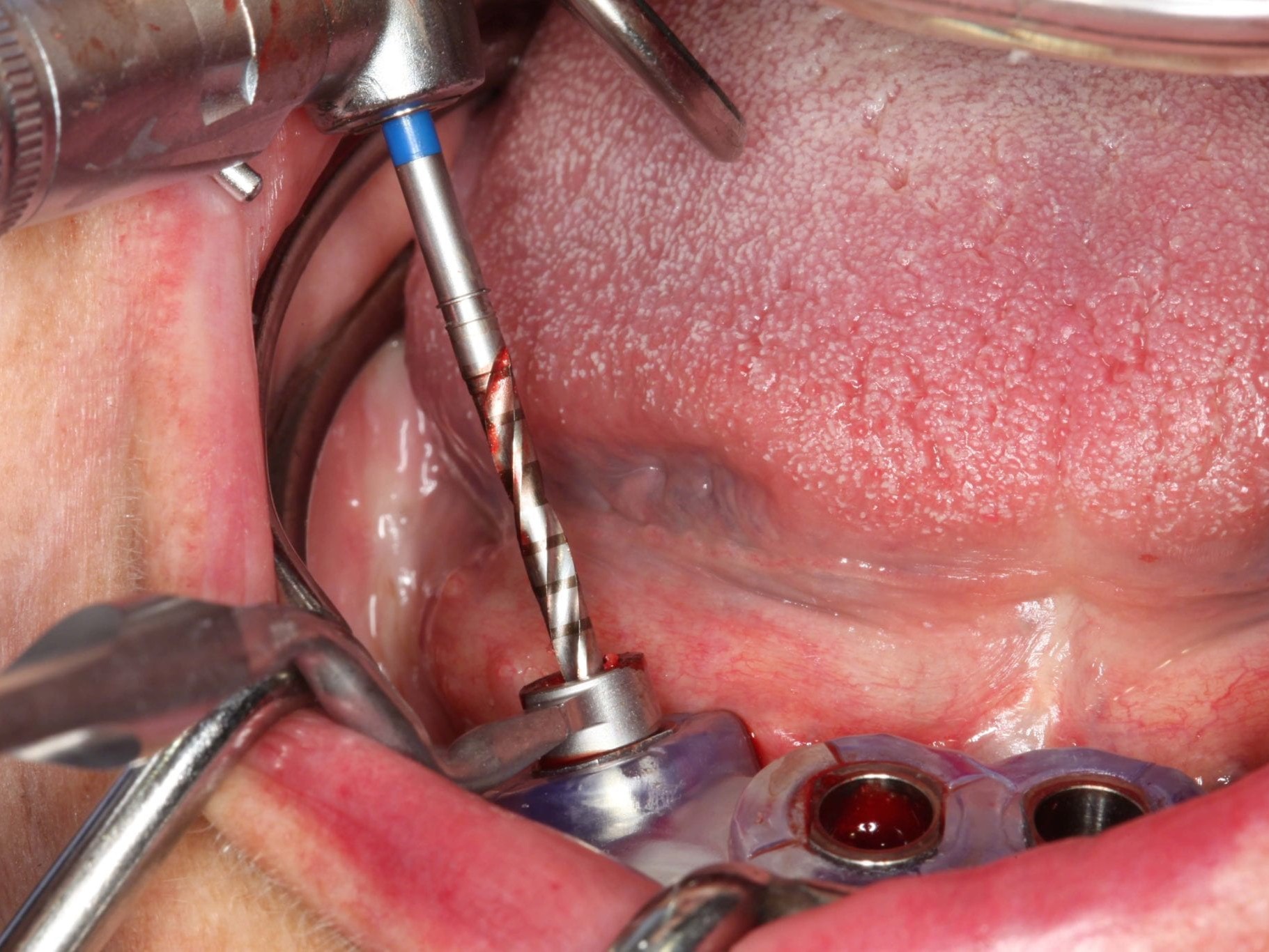 Abb 12 Initiale Aufbereitung des angulierten Implantatstollens