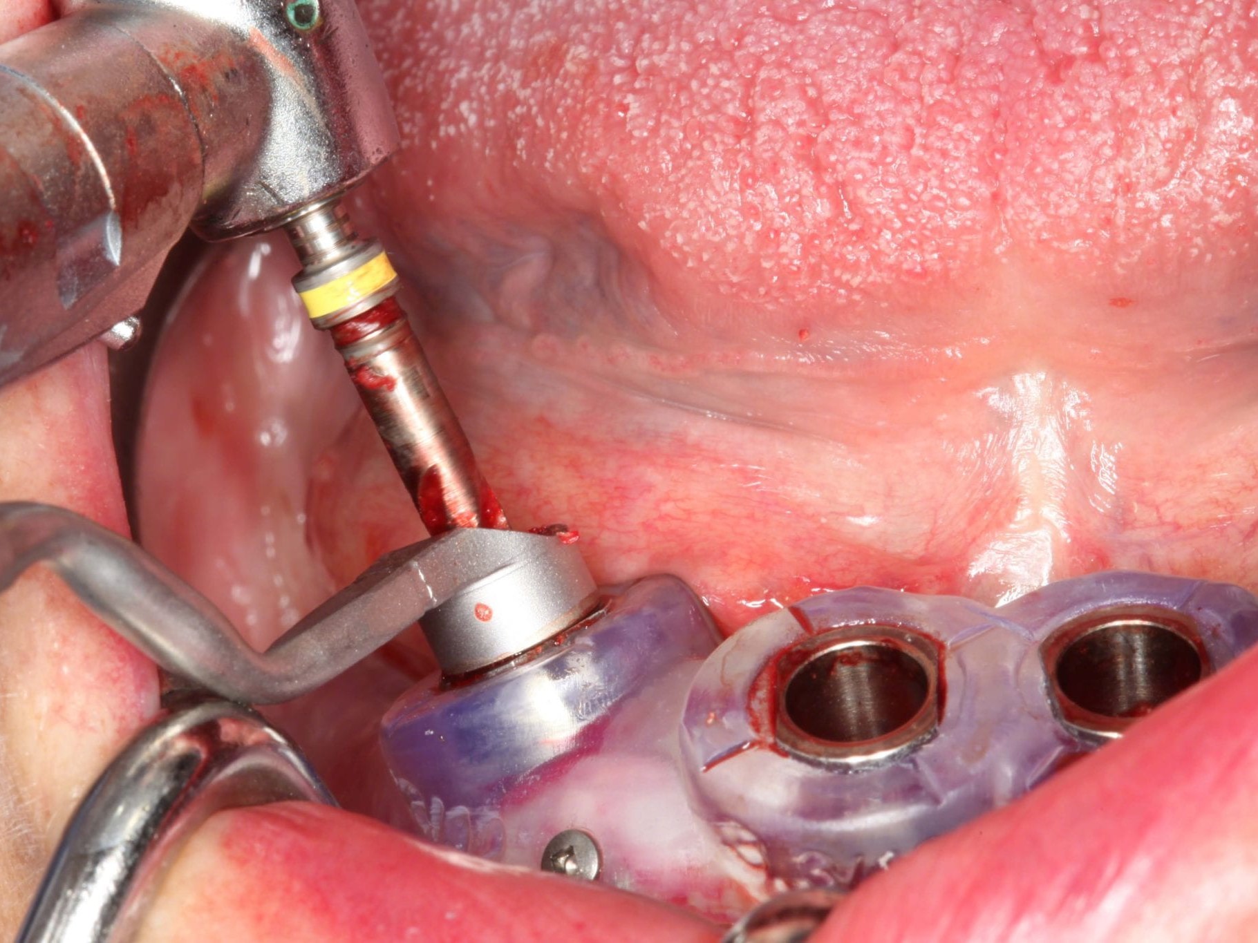 Abb 13 Aufbereitung des angulierten Implantatstollens 2. Guided Bohrer