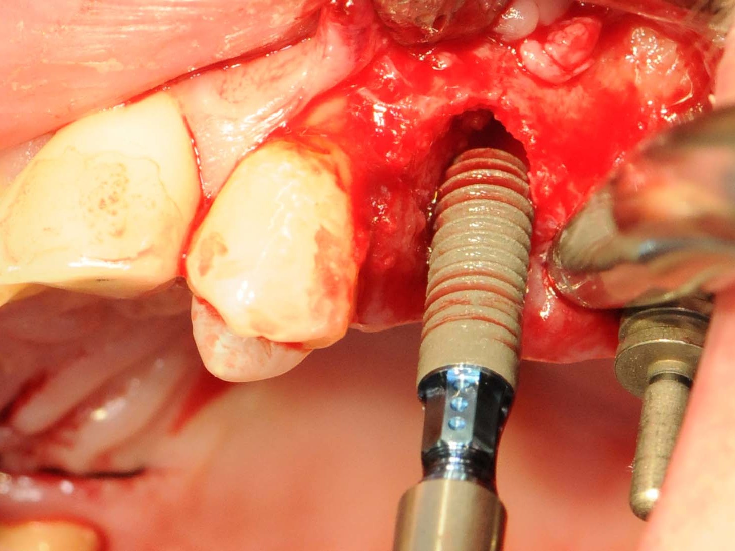 Abb 13 Straumann Bone Level Roxolid-Implantat als Sofortimplantation eingesetzt