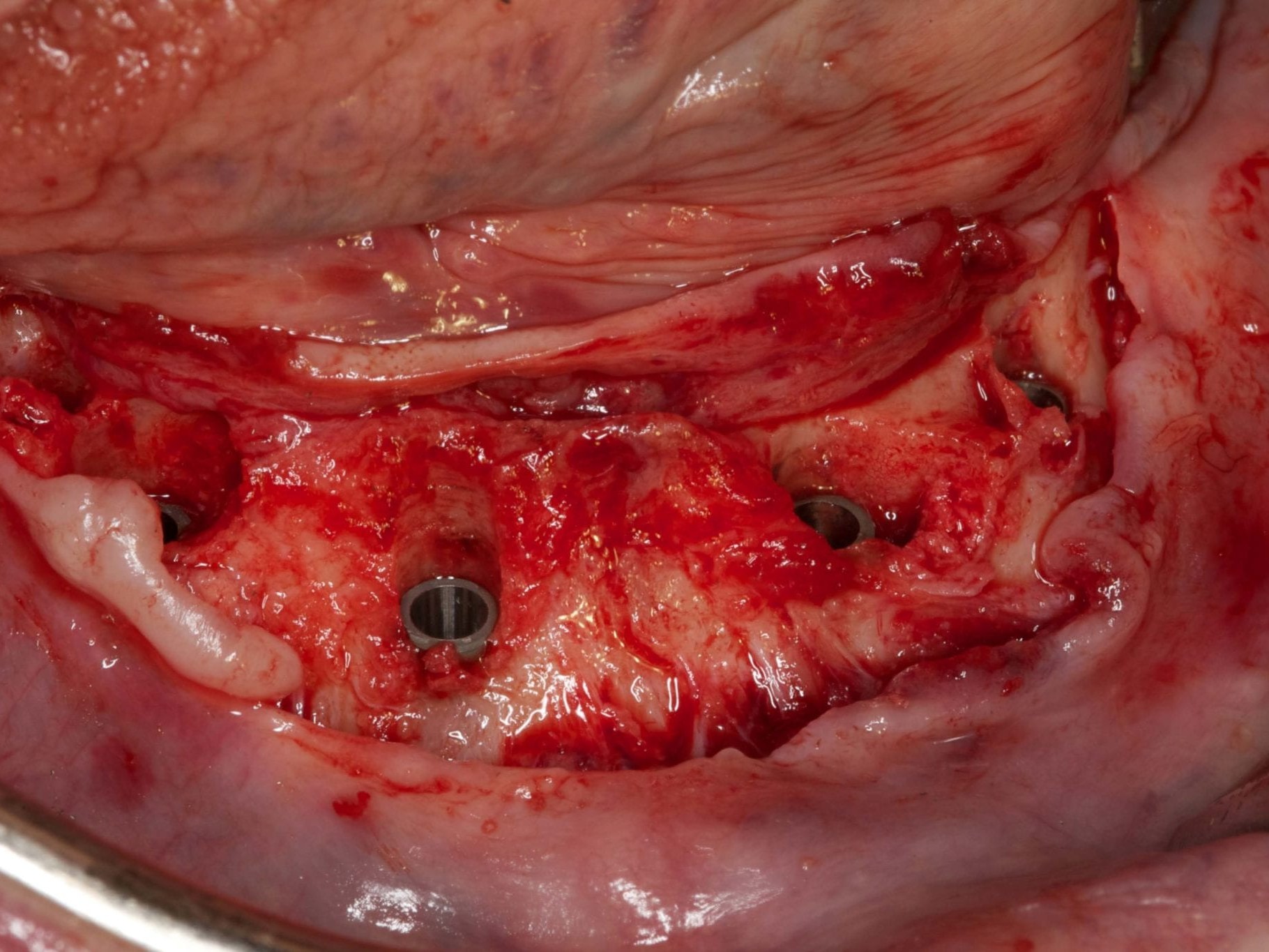 Abb 13 sämtliche Ankylos®-Implantate in situ