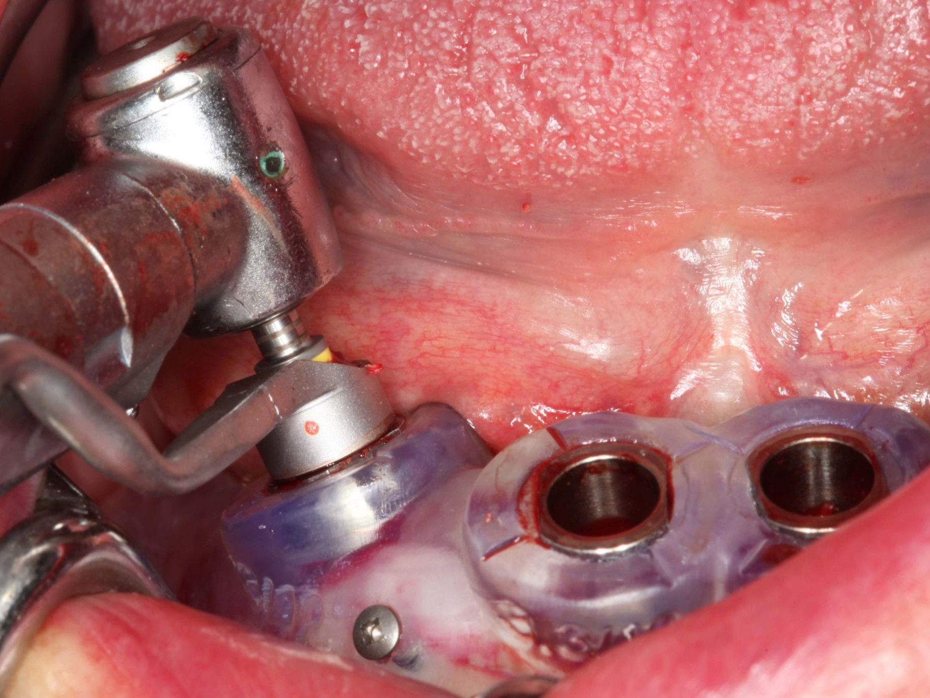 Abb 14 Aufbereitung des angulierten Implantatstollens - Guided Bohrer in finaler Position