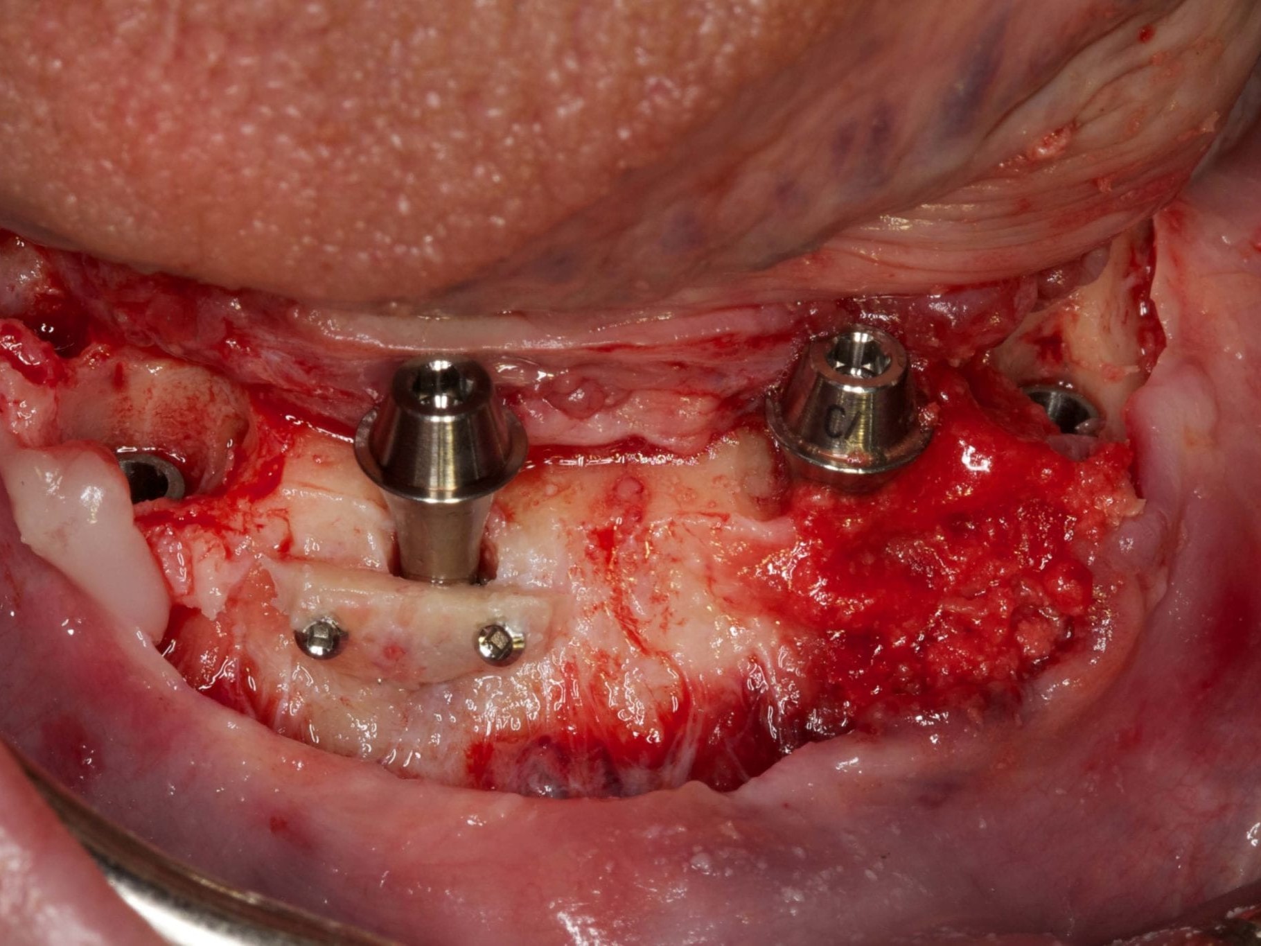 Abb 14 Endversorgte Implantate regio 032 und 042