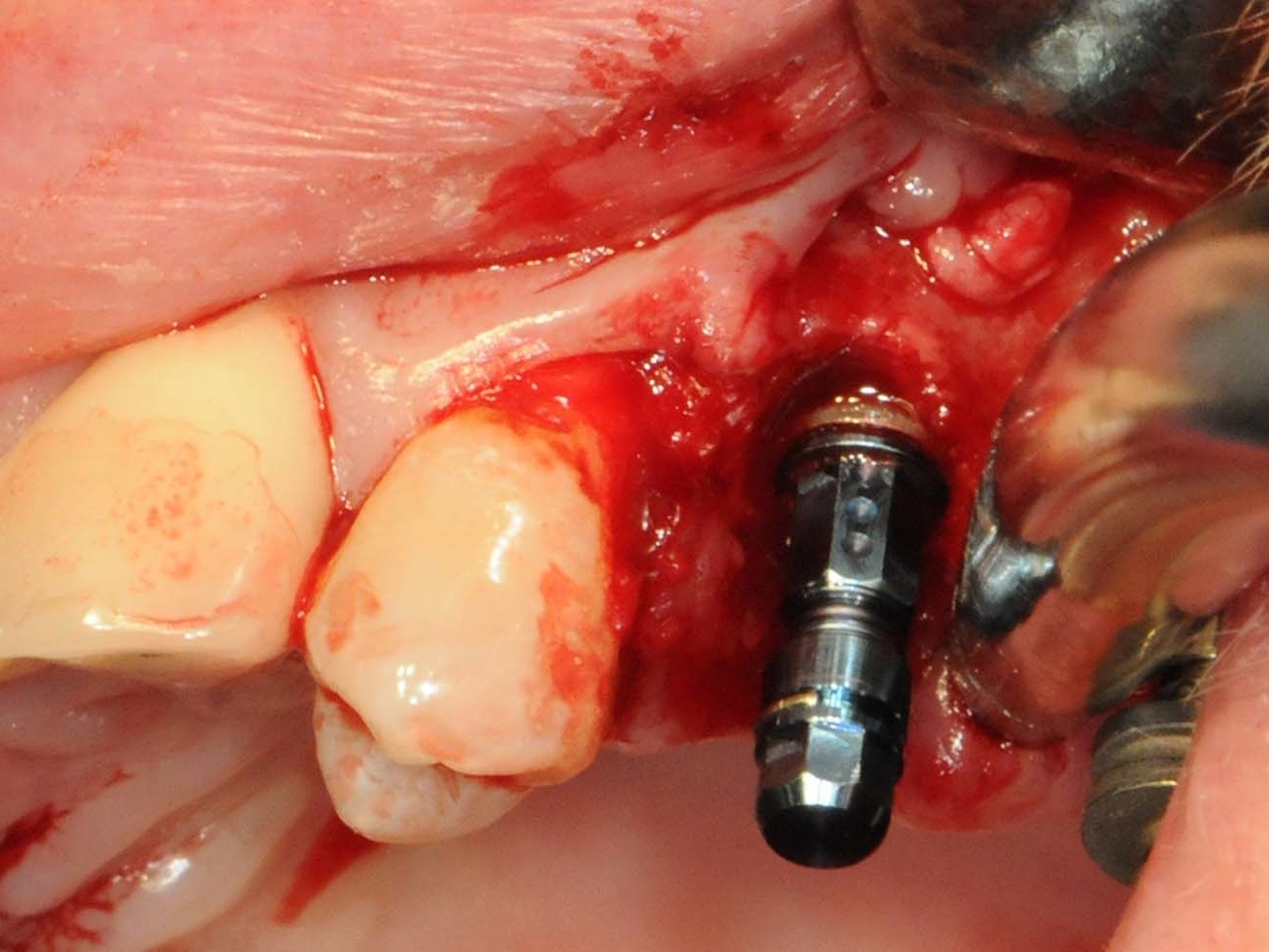 Abb 14 Straumann Bone Level Roxolid-Implantat 25 in finaler Position