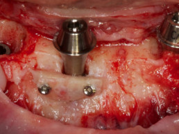 Abb 15 Knochenschale bei Implantat regio 042