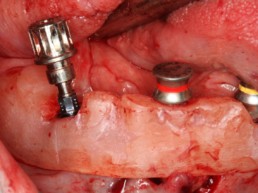 Abb 16 Insertion des das Straumann® Guided Bone Level Implantat in regio 044