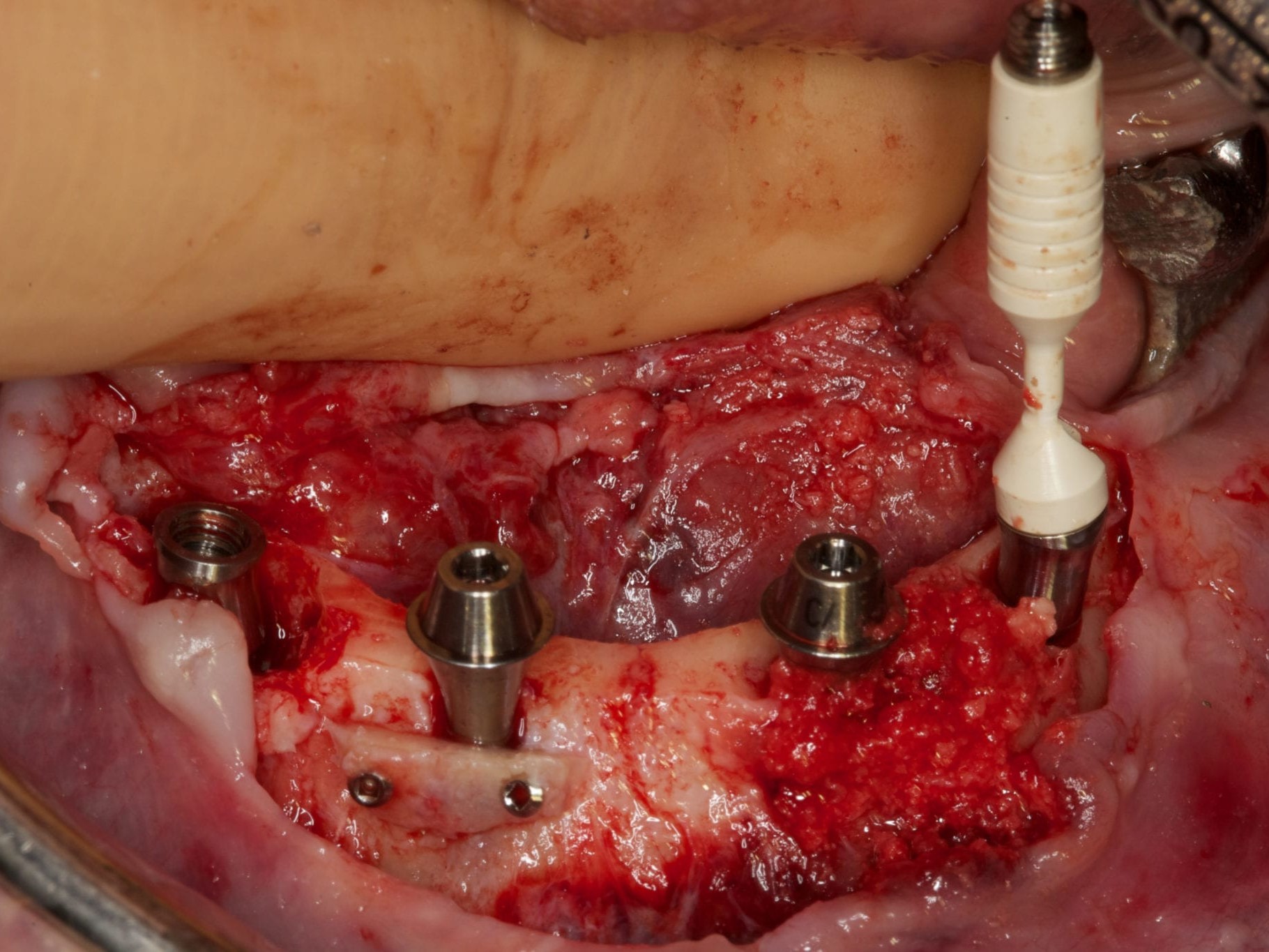 Abb 16 SmartFix-Aufbau in Einbringung