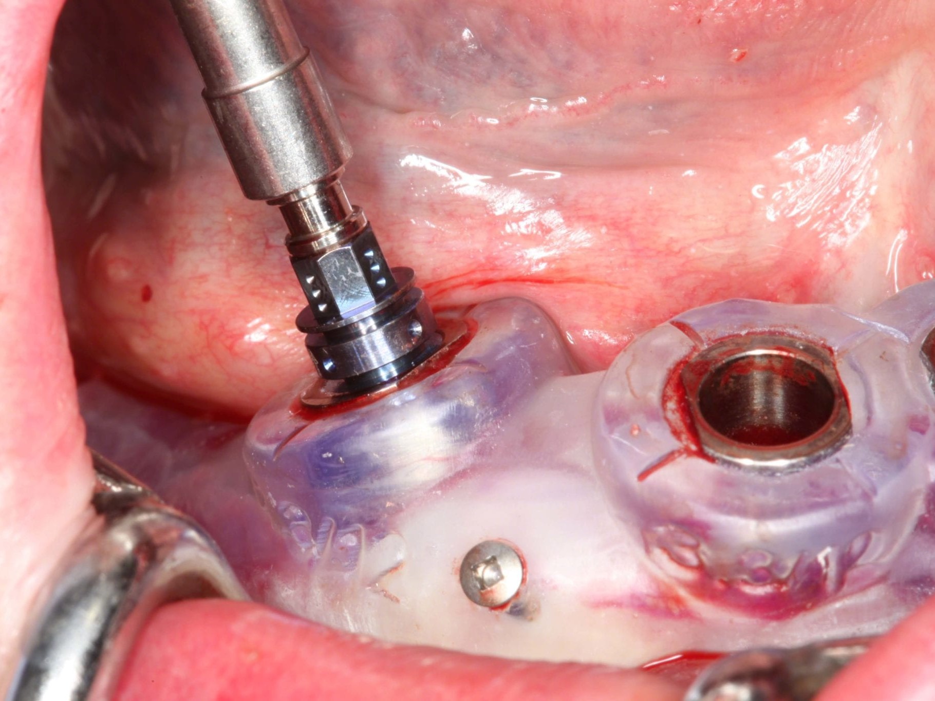 Abb 16 Überprüfung der orovestibulären Ausrichtung