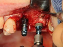 Abb 17 Implantatinsertion regio 026 durch Knochenring