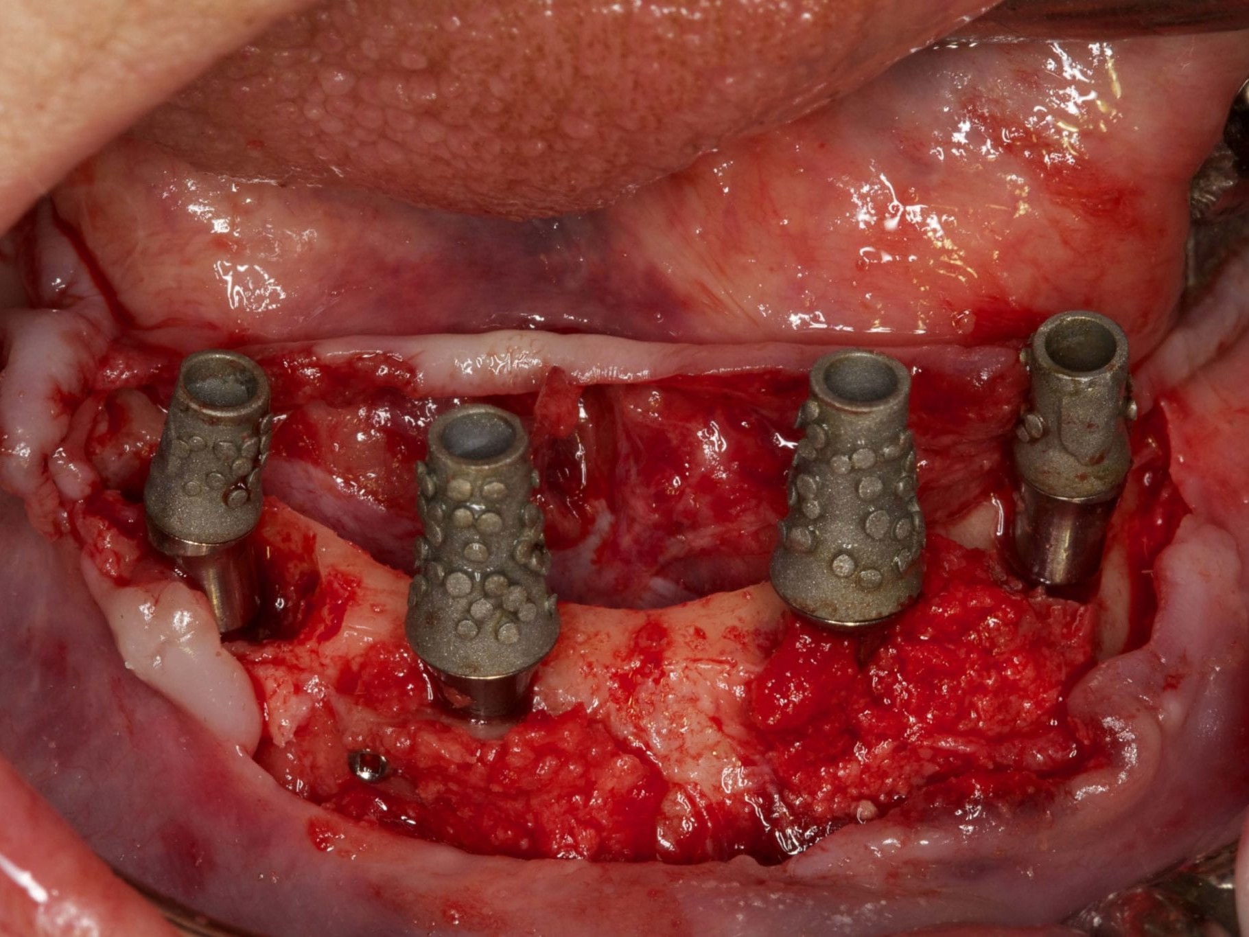 Abb 17 Sämtliche Retentionskappen in situ