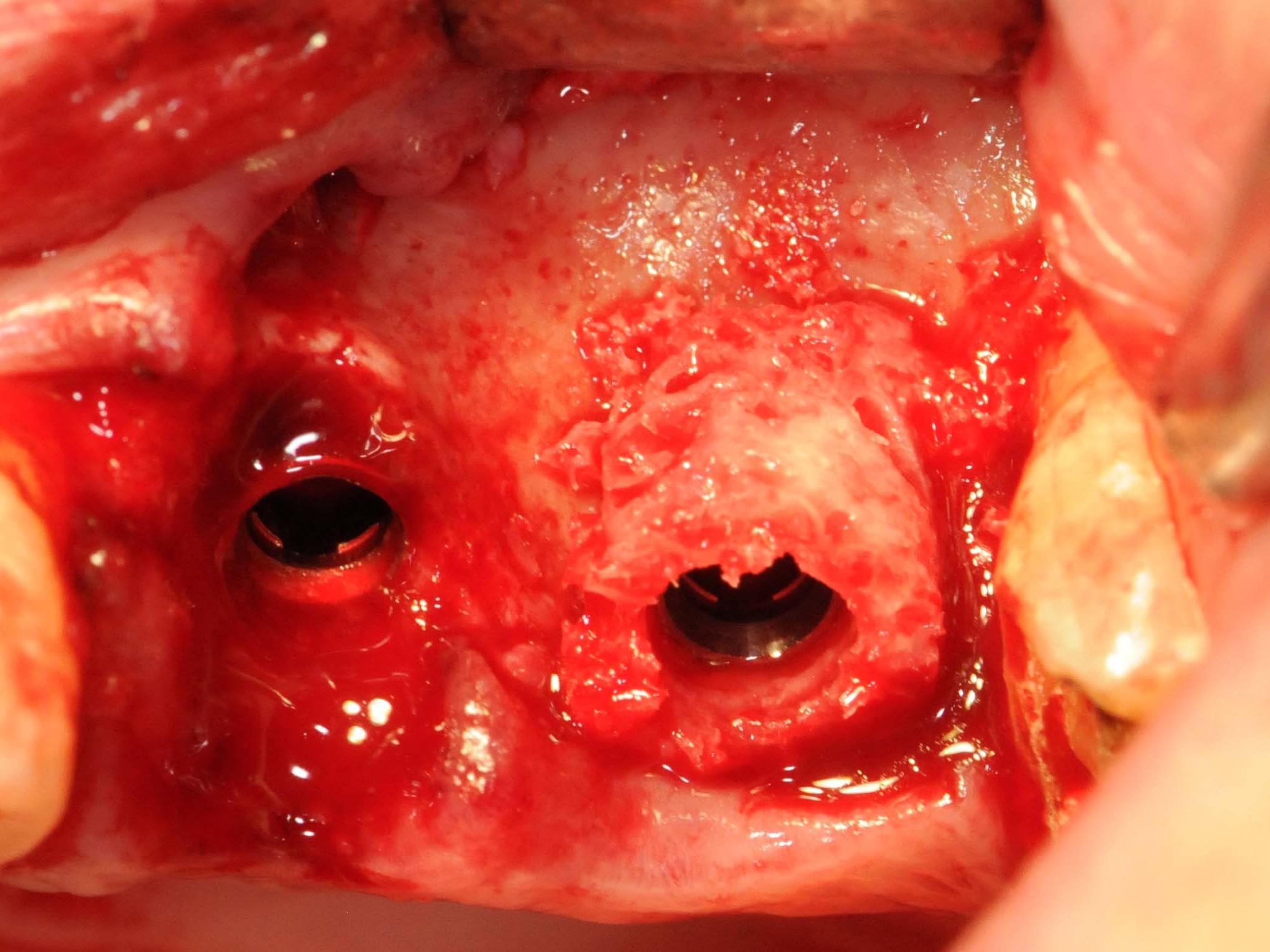 Abb 18 Implantat 026 subcrestal maschinell versenkt